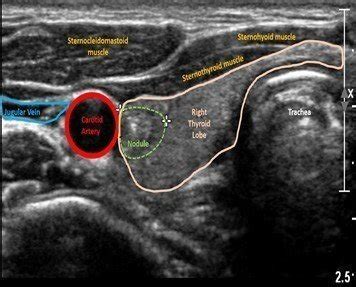 Normal Thyroid Ultrasound