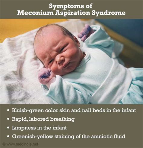 Meconium Aspiration Syndrome - Causes, Symptoms, Diagnosis ...