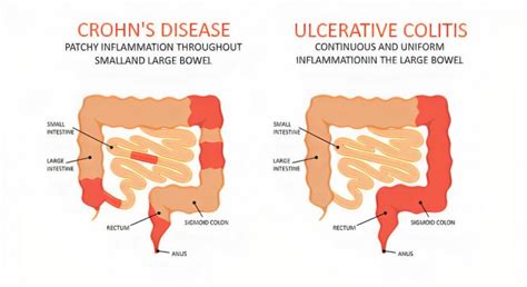 Ulcerative Colitis (UC): Causes, Symptoms, Types, Diagnosis & Treatment - Page 11 of 18 - Left ...