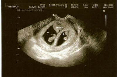 Pin by Twin Multiples Club on Ultrasound Photos of Twins & Multiples | Twins ultrasound ...