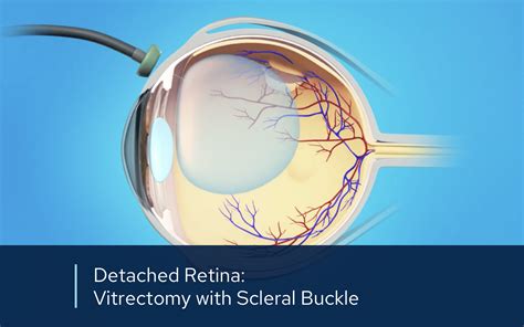 Scleral Buckle & Retina Repair | Retinal Consultants Medical Group