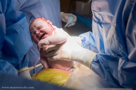 Cesarean Birth - A Midwife on the Path