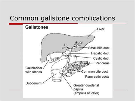 PPT - Mirizzi Syndrome An Uncommon Gallstone Complication PowerPoint ...