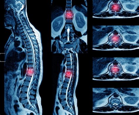 Premium Photo | Mri of the thoracic spine history: a 62-year-old male with suspected tb spine.