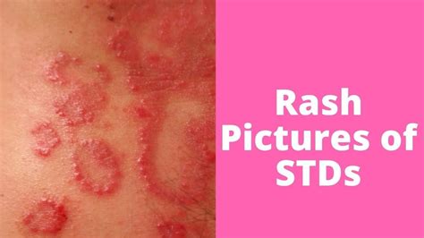 What’s This Rash Pictures of STDs | Ringworm, Acne free face, Warts on hands