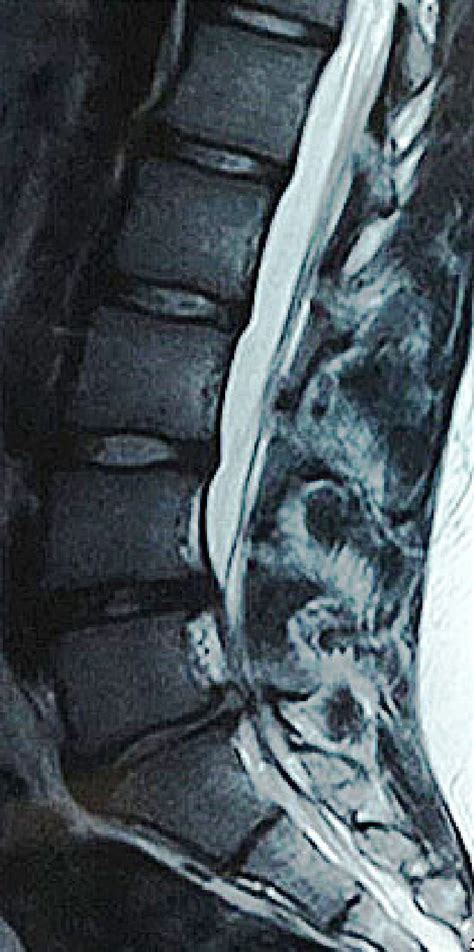 T2-weighted sagittal MRI image, disc herniation in L4-L5 and L5-S1 ...