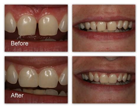 Front Teeth Fillings | Restoring Smile Solution