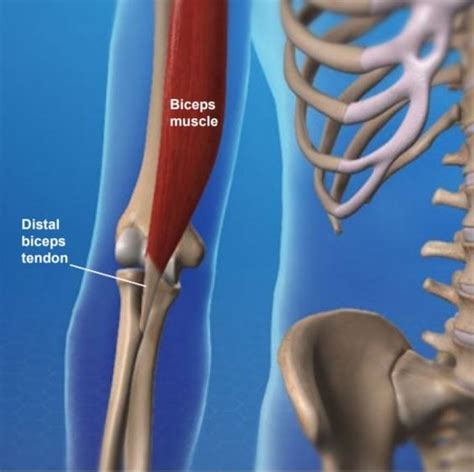 Distal Biceps Tendon Injury - Brandon P. Donnelly, MD