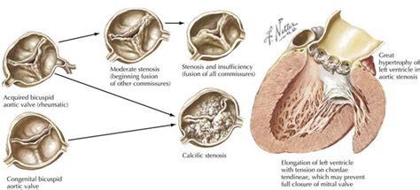 Aortic Stenosis | Thoracic Key