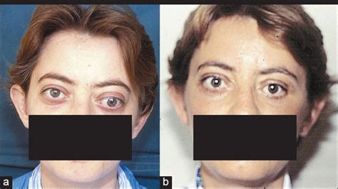 Patient with exophthalmos of 28 mm, strabismus, diplopia and eyelid... | Download Scientific Diagram