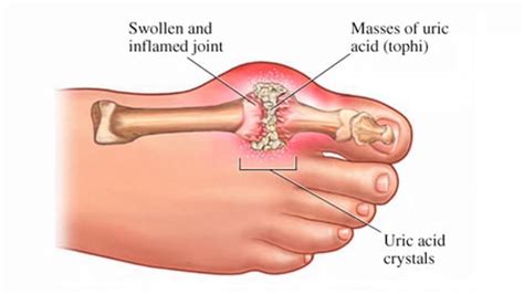 What Does High Uric Acid Levels Mean