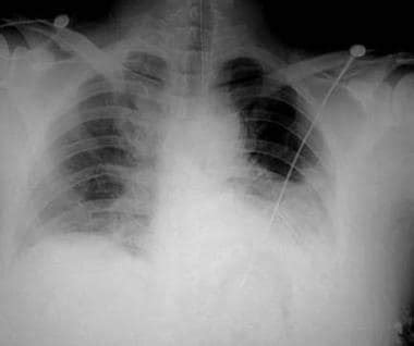 Hemothorax Workup: Approach Considerations, Laboratory Studies, Chest Radiography