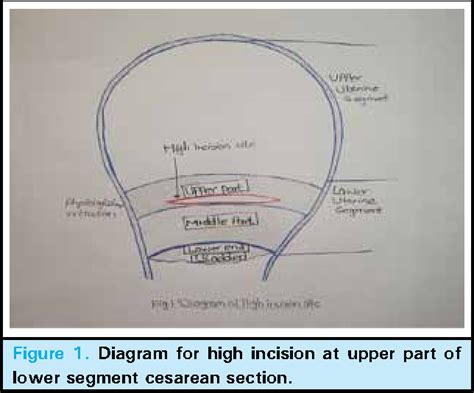 Figure 1 from Higher Incision at Upper Part of Lower Segment Caesarean ...