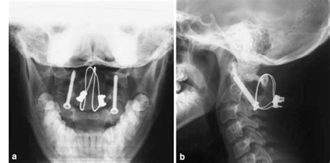 Follow-up X-rays 12 months after trauma. Stable atlantoaxial fusion... | Download Scientific Diagram