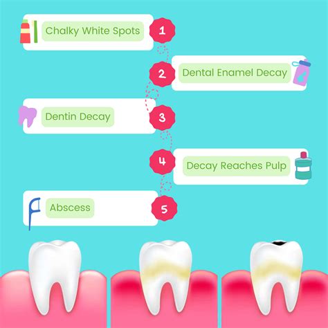 The Stages of Tooth Decay - Lakeview Pointe Dentistry