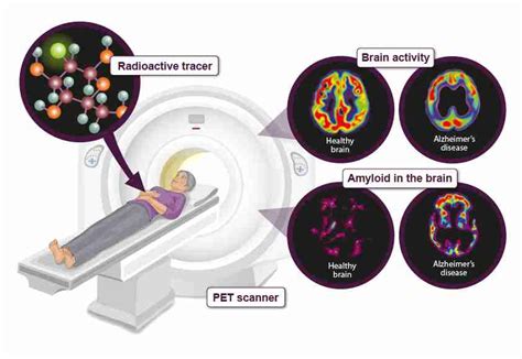 All you need to know about brain scans and dementia - Alzheimer's ...