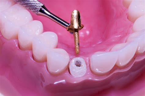 Ferrule effect improved outcomes in endodontically treated teeth? - National Elf Service