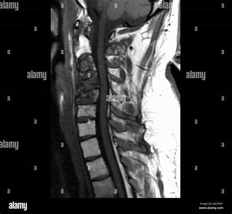 Spinal cancer. Magnetic resonance imaging (MRI) scan of a sagittal ...