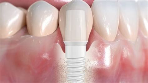 Zirconium Dental Implants in Costa Rica at America Dental Clinic