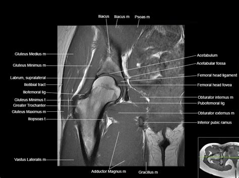 Iliofemoral Ligament Mri