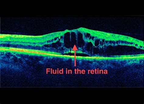 Central Vein Occlusion Treatment | Retinal Consultants Medical Group