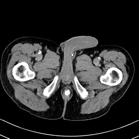 File:Chronic appendicitis complicated by appendicular abscess, pylephlebitis and liver abscess ...