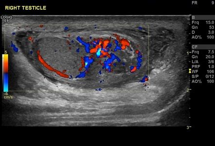 Infantile chronic calcific epididymitis | Radiology Case | Radiopaedia.org