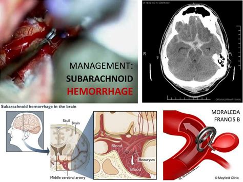 PPT - Neurosurgery Case 3: Subarachnoid Hemorrhage PowerPoint ...