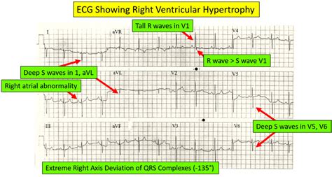 Right Ventricular Hypertrophy ECG Criteria