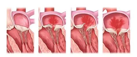 心脏瓣膜脱垂-京东健康