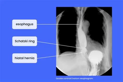 Schatzki Ring: Symptoms, Causes, and Treatment