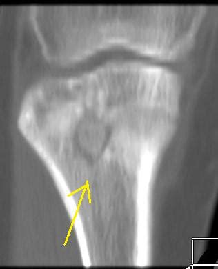 Brodie's Abscess-CT - Sumer's Radiology Blog