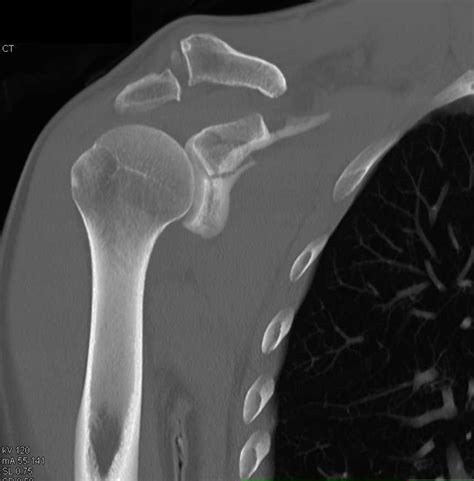 Glenoid Fracture and Widening of the AC Joint - Musculoskeletal Case Studies - CTisus CT Scanning