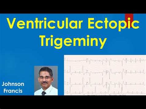 Ventricular Ectopic Trigeminy - YouTube