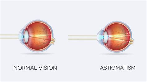 Astigmatism: Causes, Definition, Types, Treatment, 60% OFF