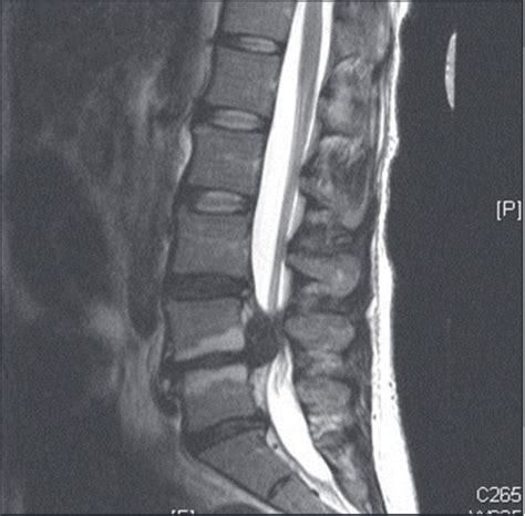 Cauda equina syndrome from lumbar disc herniation | Cauda equina, Cauda equina syndrome, Lumbar disc