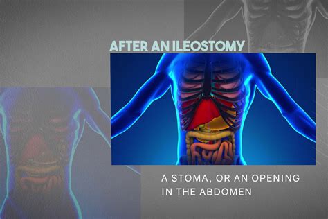 What to Expect After an Ileostomy for UC