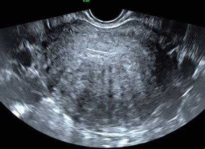 How to Diagnose Adenomyosis? - Sydney Fibroid Clinic