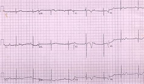 Congenital complete heart block – exercise response – All About Cardiovascular System and Disorders