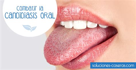 La candidiasis oral es una infección que afecta a la boca y que causa ...