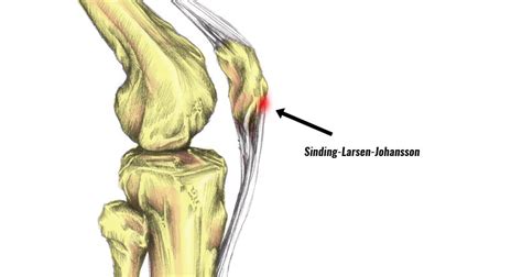 Sinding-Larsen-Johansson syndrome: Symptoms, Causes & Treatment