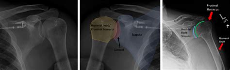 Shoulder Dislocation with Fracture (Shoulder Dislocation with Broken ...