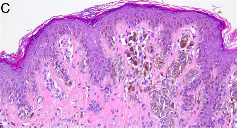 Compound Nevus Histology