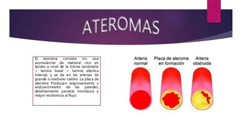 Ateroma