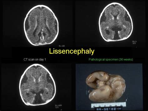 Ultrasound in Lissencephaly