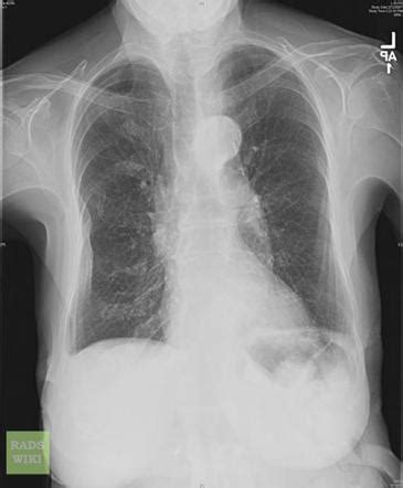 Chronic obstructive pulmonary disease | Radiology Reference Article ...