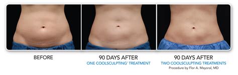 CoolSculpting | Freeze the Fat | Beverly Hills | Los Angeles | West Hollywood