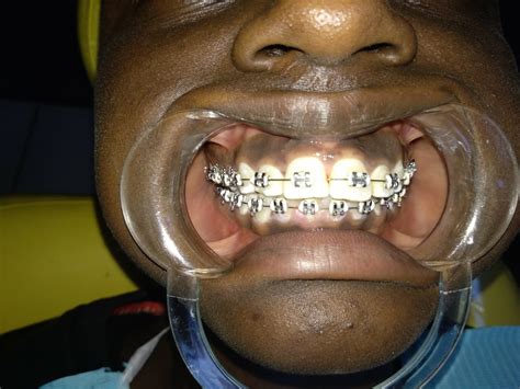 Braces for Teeth Alignment in Nairobi | Kisumu – Lake Dental Clinic