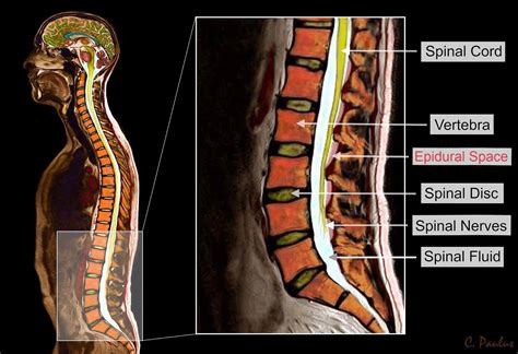 Lumbar Spine MRI | Mri Scan Images