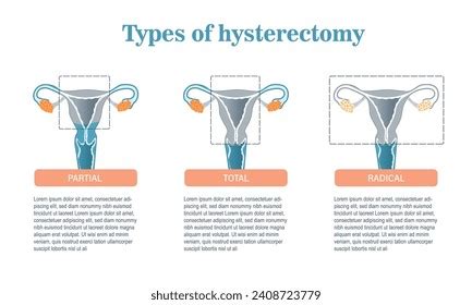 Infographic On Types Hysterectomy Surgery Treatment Stock Vector ...